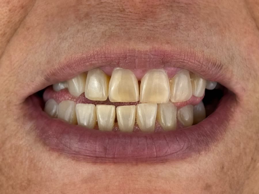 Sorriso de paciente antes do clareamento caseiro, com os dentes amarelados