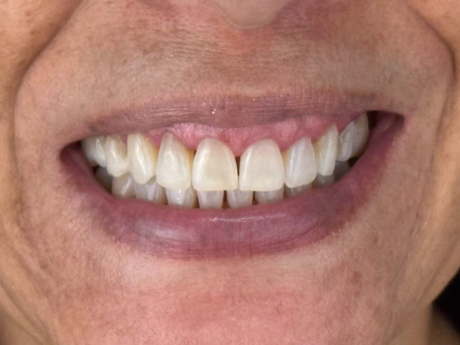 O mesmo sorriso depois do clareamento caseiro, com os dentes visivelmente mais claros