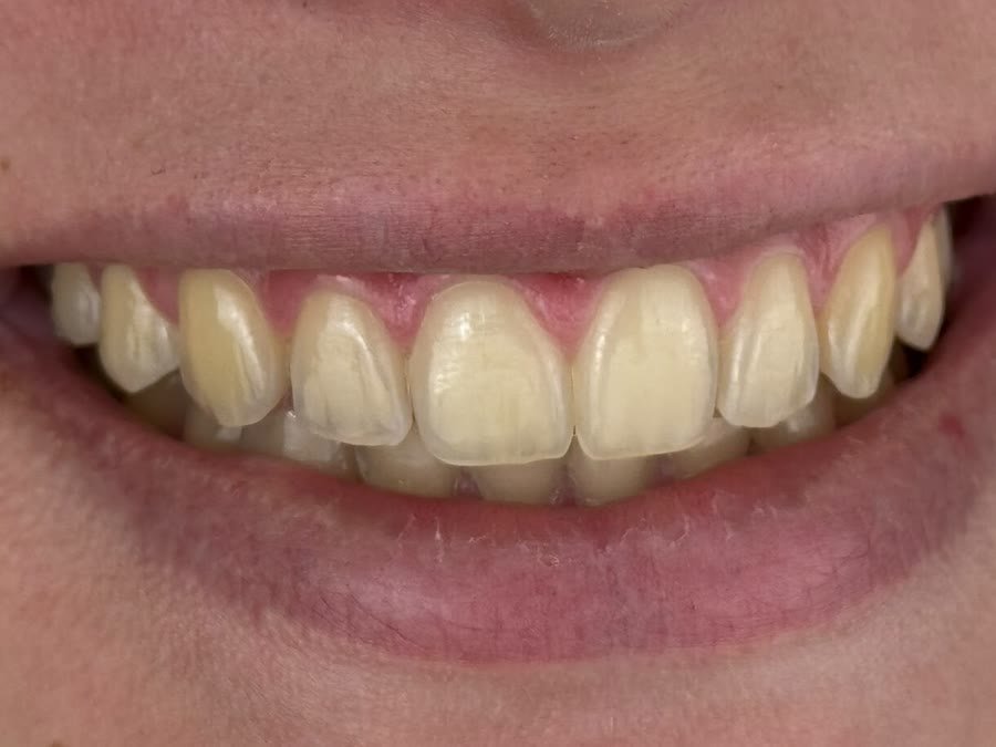 Sorriso de paciente antes do clareamento caseiro, com tom amarelado nos dentes da frente