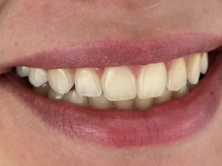 O mesmo sorriso depois do clareamento caseiro, com os dentes mais brancos e uniformes