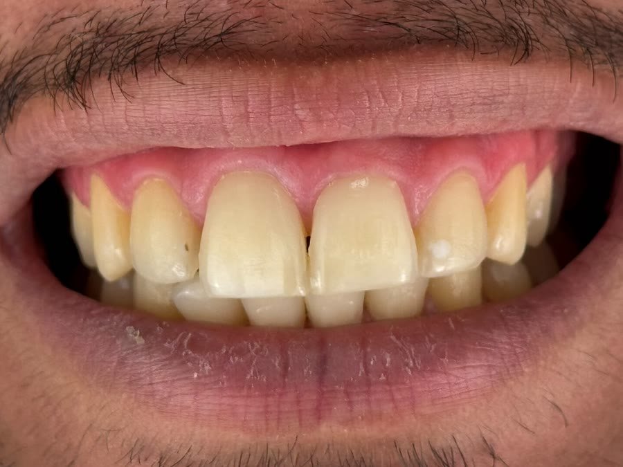 Sorriso de paciente homem antes do clareamento caseiro, com os dentes escurecidos
