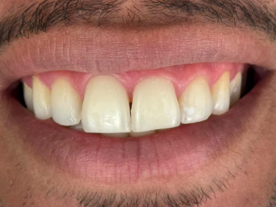 O mesmo sorriso depois do clareamento caseiro, com os dentes bem mais claros