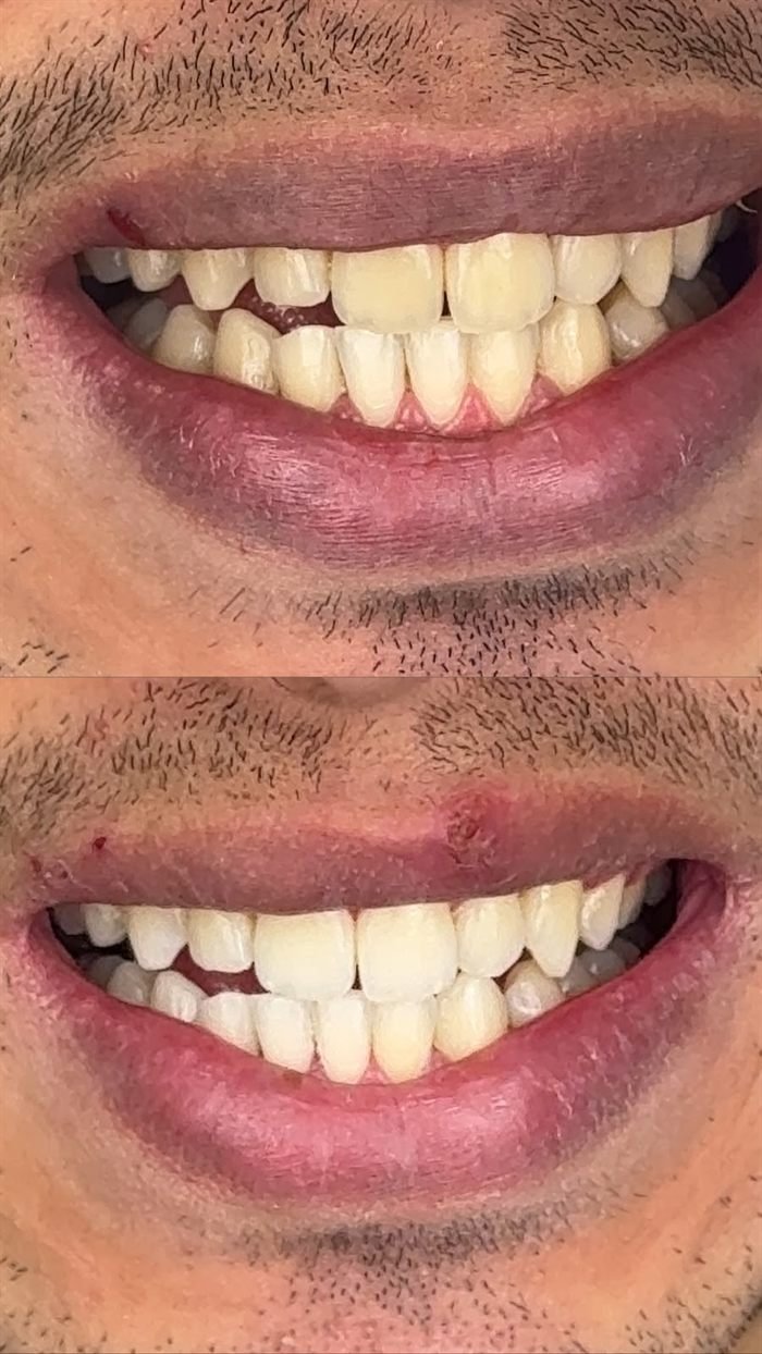 Antes e depois do clareamento caseiro de um paciente da Sorrivan: dentes amarelados acima e o mesmo sorriso bem mais claro abaixo