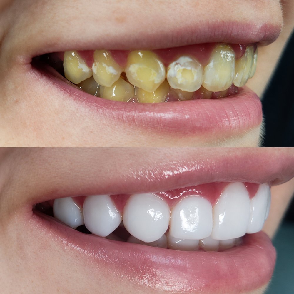 Antes e depois de lentes em resina feitas na Sorrivan: dentes amarelados e manchados viraram um sorriso branco e alinhado
